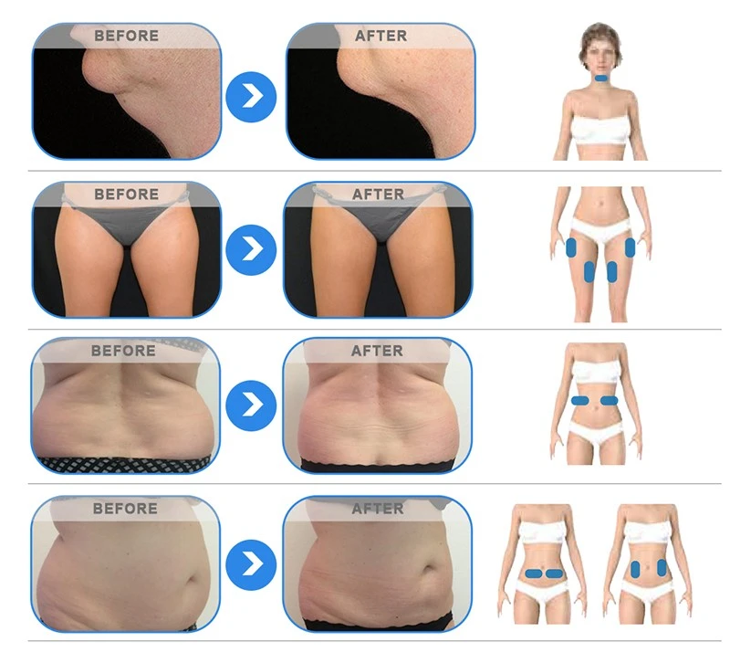 360 Cryolipolysis Thermal Shock EMS Body Sculpting Machine price