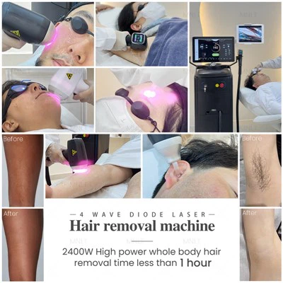 Magni tat-Tneħħija tax-Xagħar tal-Laser Diode Għall-Korp U l-Wiċċ